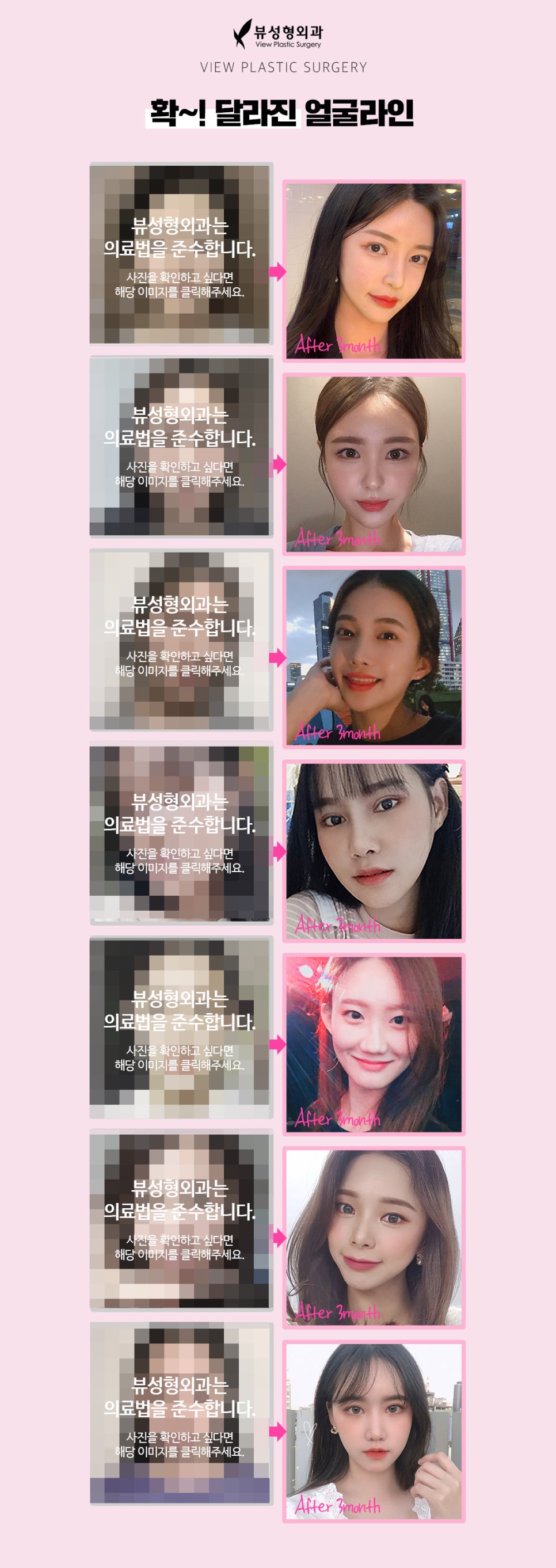 안면윤곽후기, 붓기는 얼마나 갈까? 관련 이미지 6