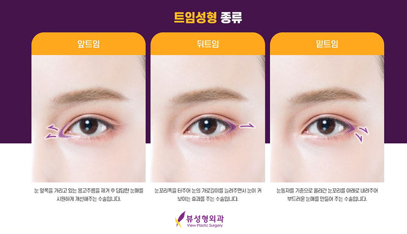 내게 맞는 눈성형을 위한 수술방법 관련 이미지 9