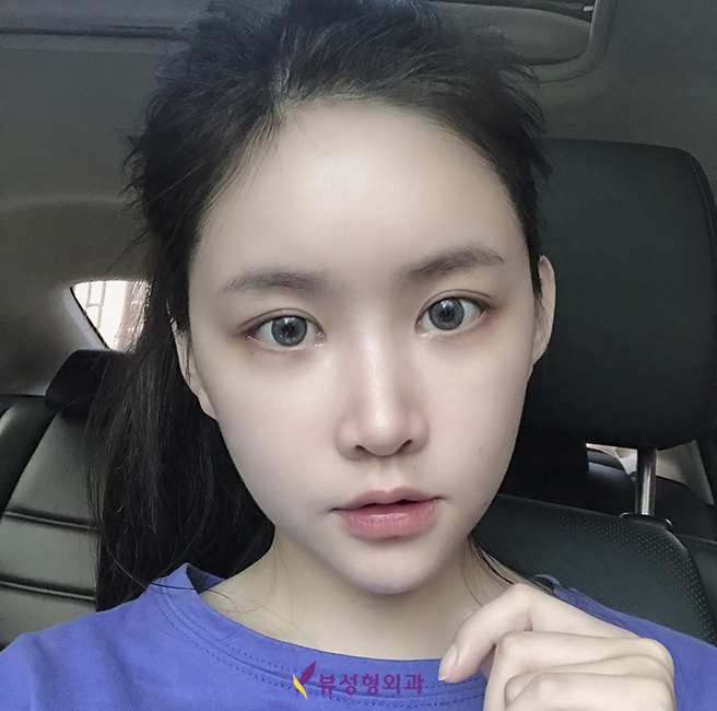 눈매교정으로 또렷하고 매력적인 눈매를 관련 이미지 1