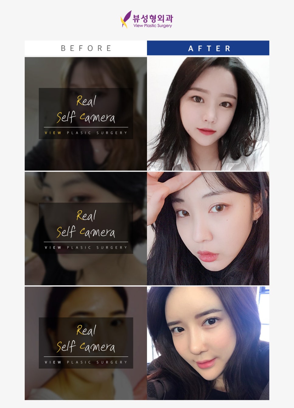 실리프팅 VS 안면거상술, 피부 상태에 맞는 맞춤리프팅 관련 이미지 8