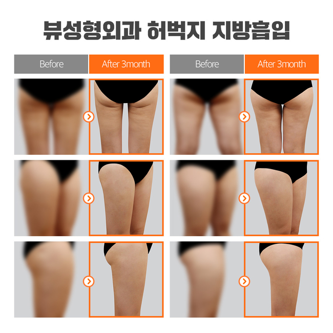 원하는 부위만 쏙쏙 지방흡입으로 지방뿌시기! 관련 이미지 8