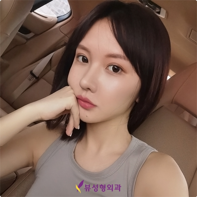 뷰성형외과 매부리코교정, 포인트는? 관련 이미지 1