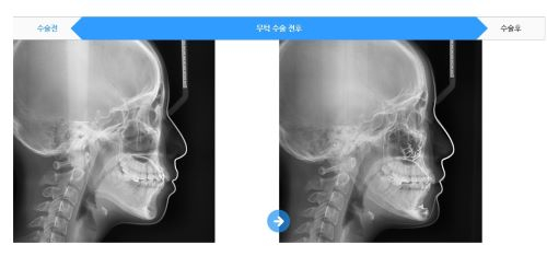 무턱때문에 고민이라면 VIEW로! 관련 이미지 3