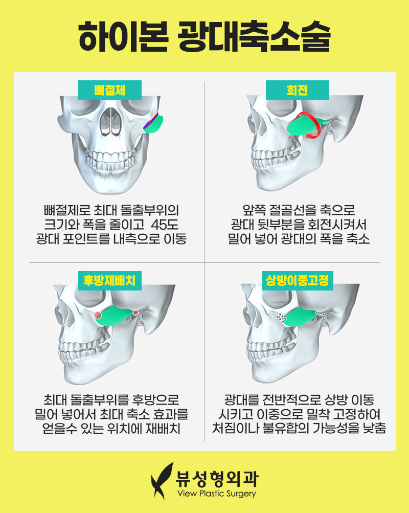 남자안면윤곽수술 개성을 살려서 관련 이미지 7