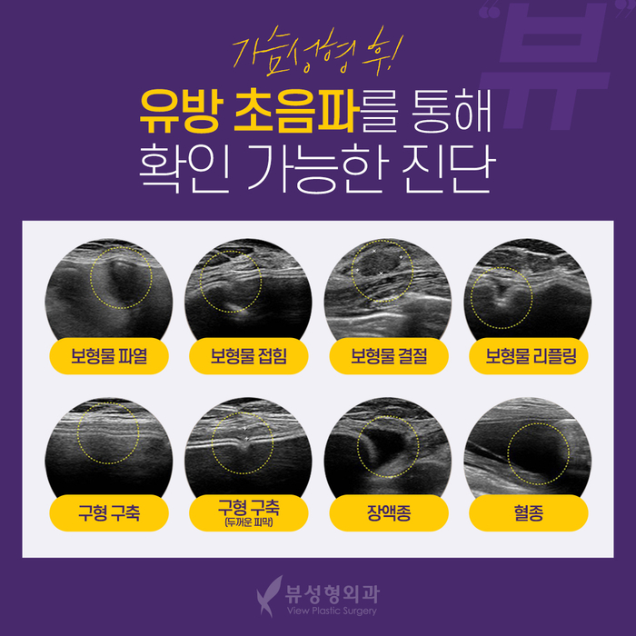 가슴성형 모양과 촉감은 기본, 안전은 필수! 관련 이미지 17