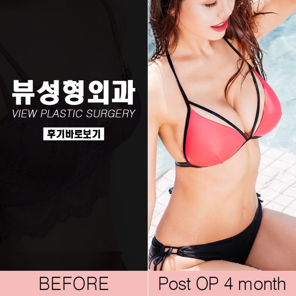 가슴성형후기 뷰성형외과 확실히 보여드릴께요 관련 이미지 4