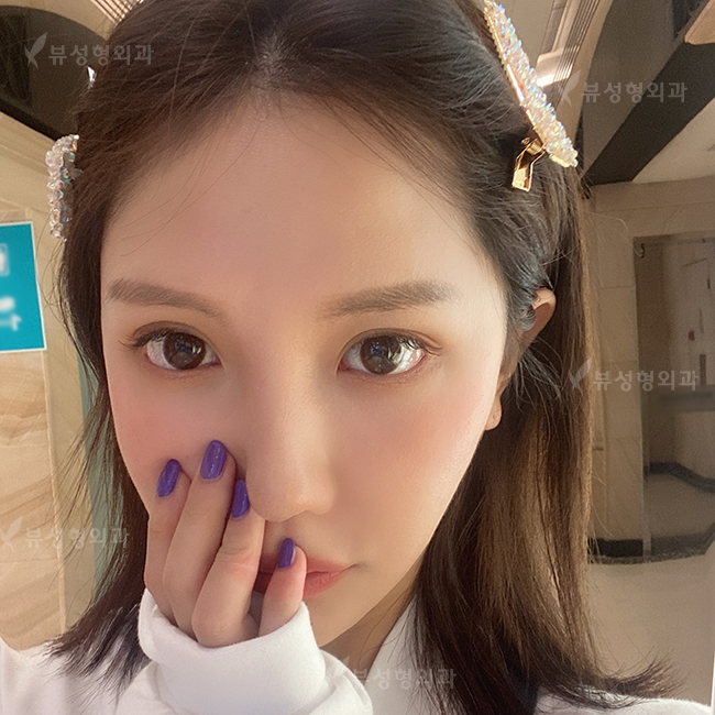 쌍꺼풀수술 나한테 적합한 수술방법은? 관련 이미지 8