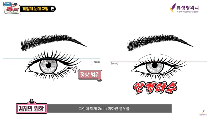 나만의 눈성형을 위한 수술방법 알아보기 관련 이미지 10