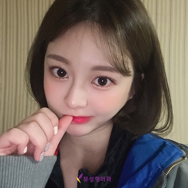 안검하수눈매교정 졸려보이는눈 해결해요 관련 이미지 7