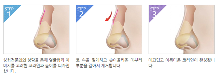 얼굴의 비율과 균형, 조화를 이루는 코성형 관련 이미지 6