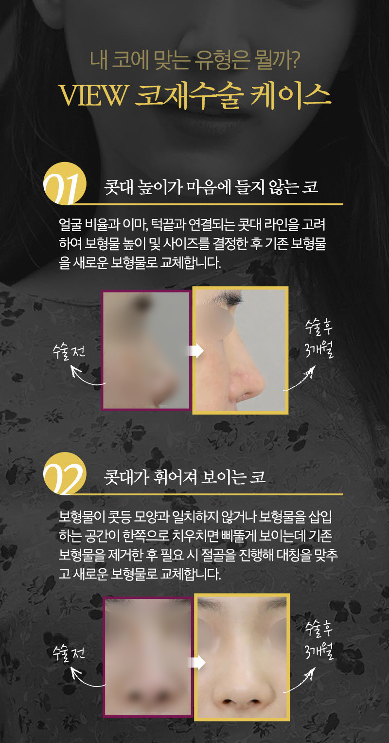코재수술후기 꼼꼼하게 따져 보아야 할 점은 관련 이미지 4