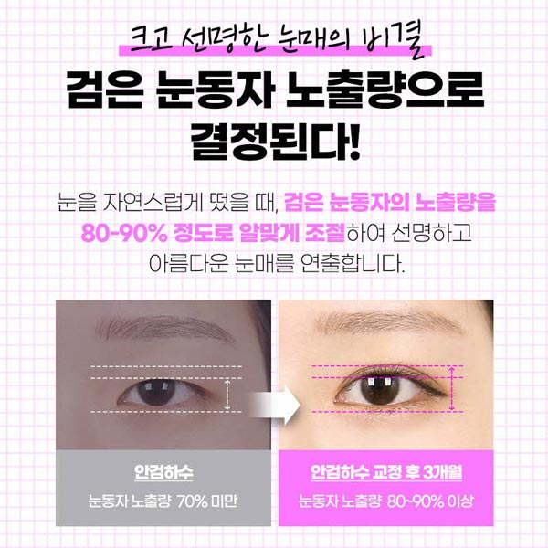 안검하수눈매교정 쌍꺼풀수술 차이점은? 관련 이미지 3