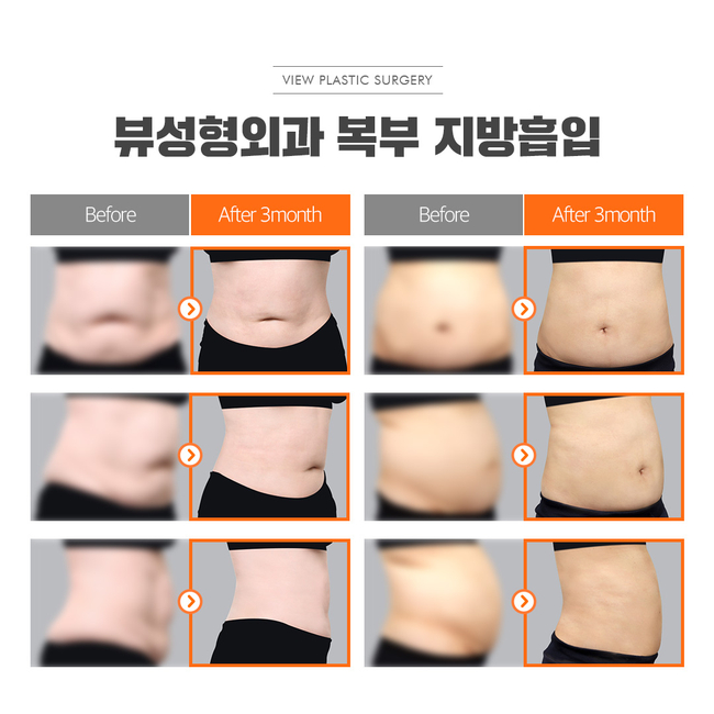 원하는 부위만 쏙쏙 지방흡입으로 지방뿌시기! 관련 이미지 6