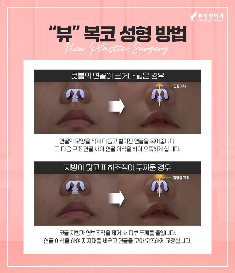 코성형, 개인별 유형에 적합한 수술방법은? 관련 이미지 14