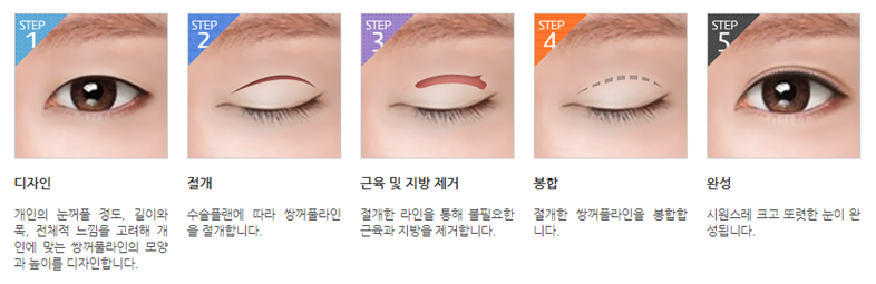 내 눈에 맞는 눈성형, 유형별 총 정리 관련 이미지 3