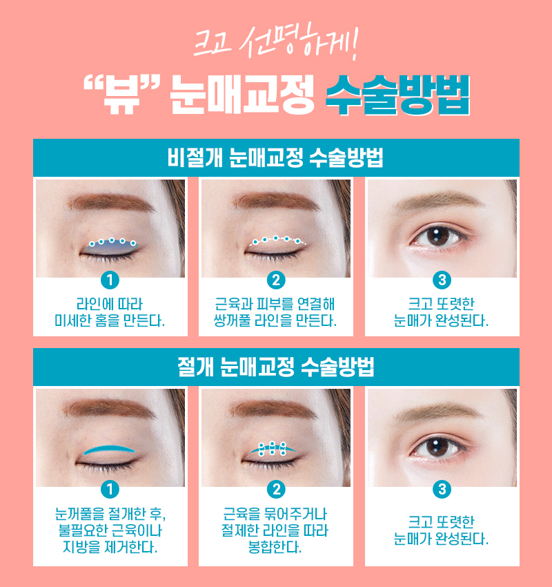 눈성형외과 중요한 점부터 관련 이미지 5