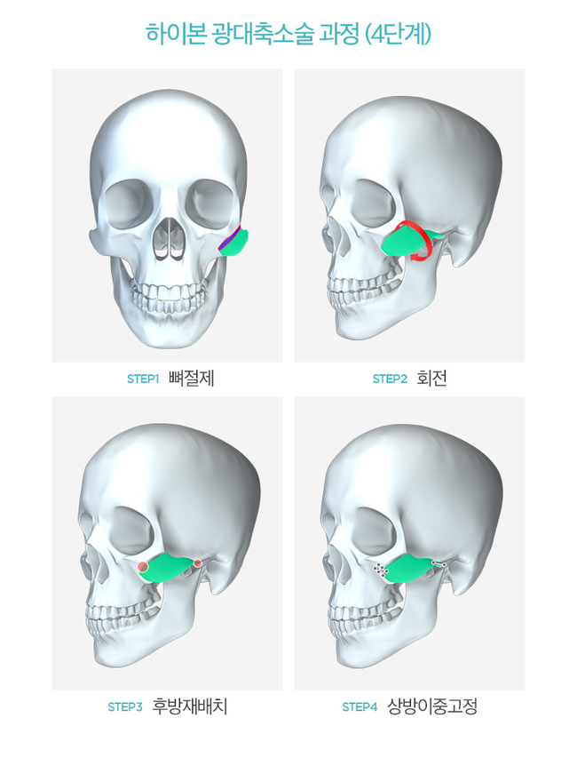 하이본 광대축소로 어느 각도에서나 갸름하게♥ 관련 이미지 3