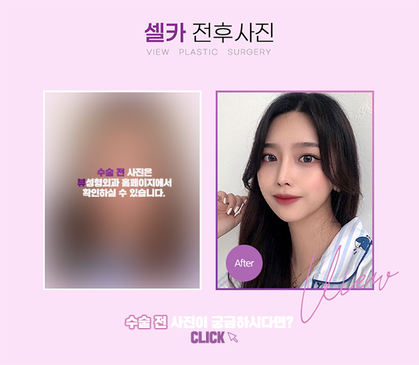 자연스러운코성형 만족도 높은 결과를 위해서는 관련 이미지 17