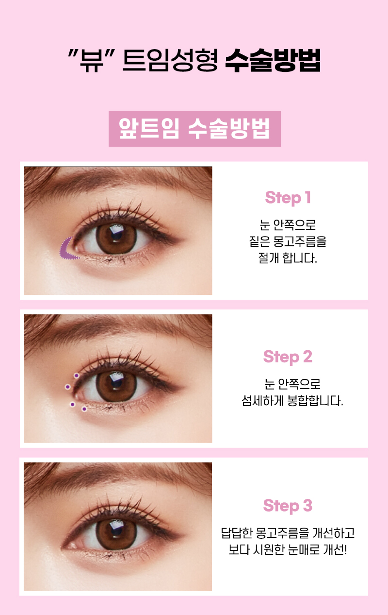 확대한듯 크고 또렷한 눈, 뷰성형외과 눈트임수술 관련 이미지 6