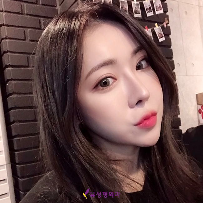 낮은코수술 뷰성형외과 조화롭고 오똑하게 관련 이미지 2