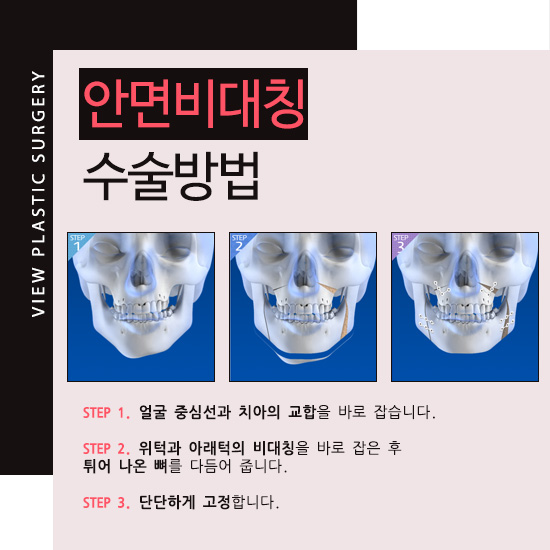 안면비대칭으로 얼굴의 균형을 바로잡다! 관련 이미지 3