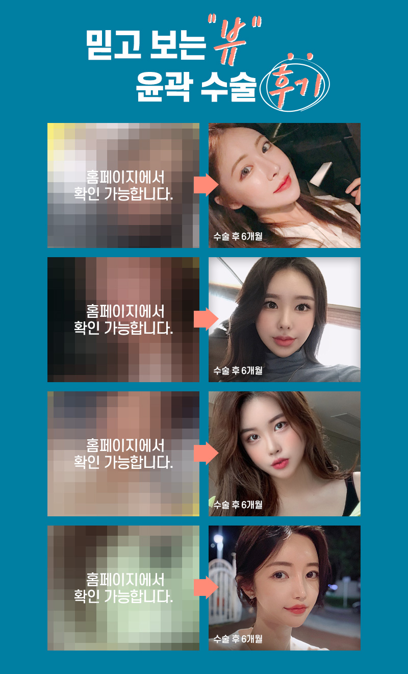 안면윤곽가격과 함께 꼭 따져봐야 할 것은? 관련 이미지 10