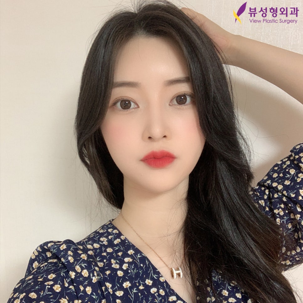 쌍꺼풀 절개법과 매몰법, 어떤 방법이 더 좋을까? 관련 이미지 4