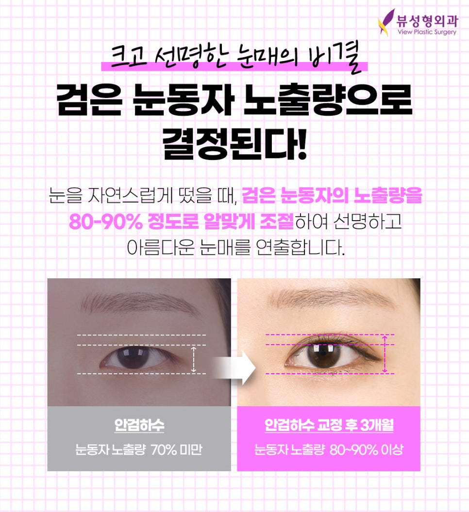 쌍꺼풀수술잘하는병원 알아보고 있다면 관련 이미지 4