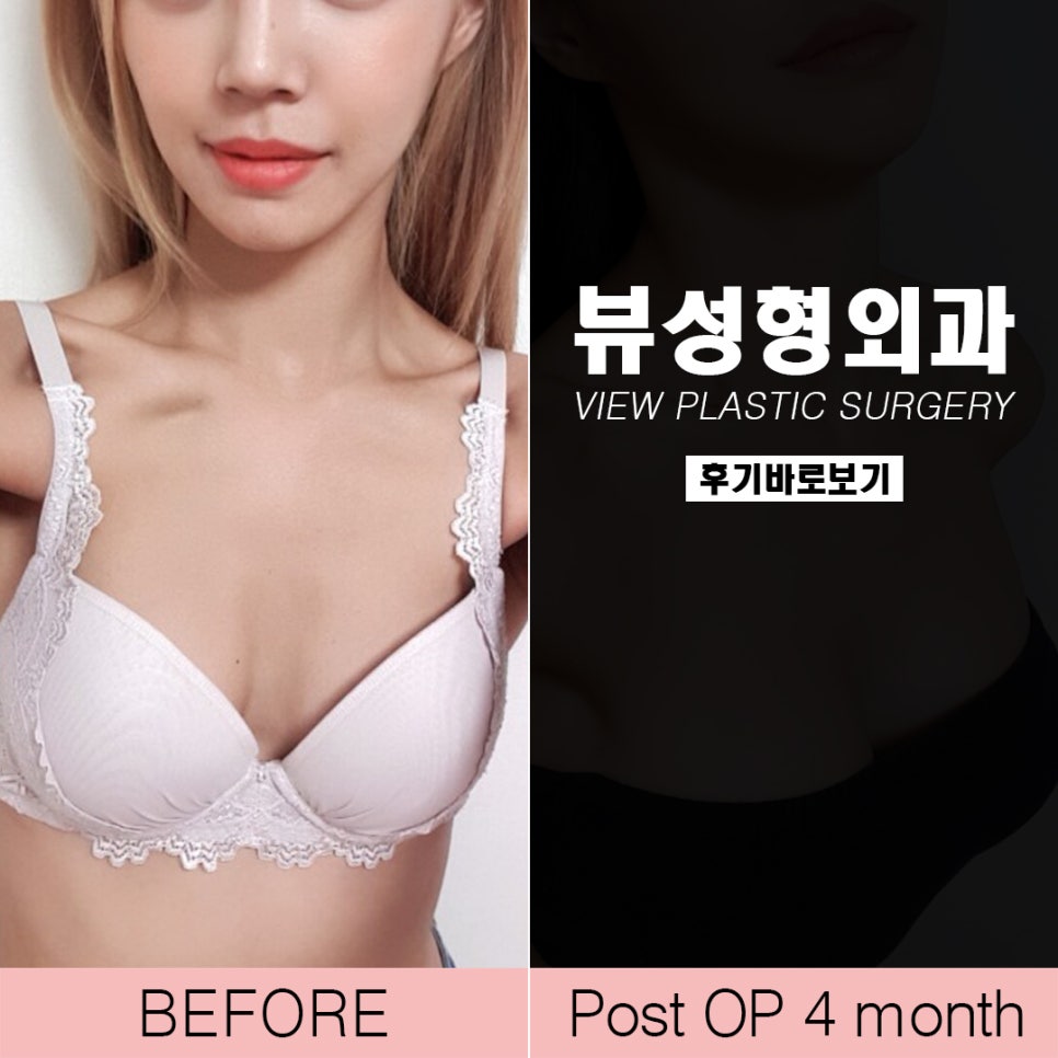 가슴성형후기 뷰성형외과 확실히 보여드릴께요 관련 이미지 3