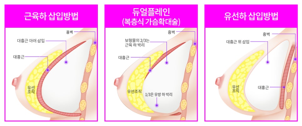 자연스런 가슴성형, 본인에게 적합한 보형물 및 절개방법 선택 중요 관련 이미지 7