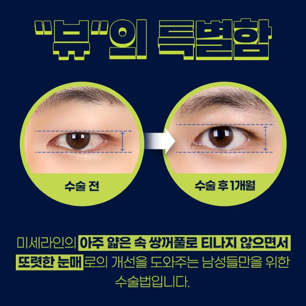자연스럽고 또렷한 남자쌍꺼풀수술을 원한다면 관련 이미지 2
