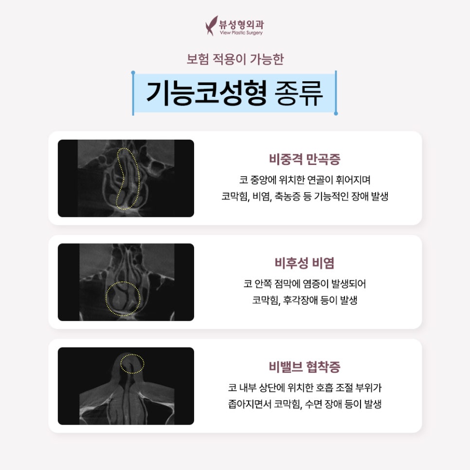예쁘고 건강한 코, 비염치료와 코성형을 동시에 관련 이미지 3