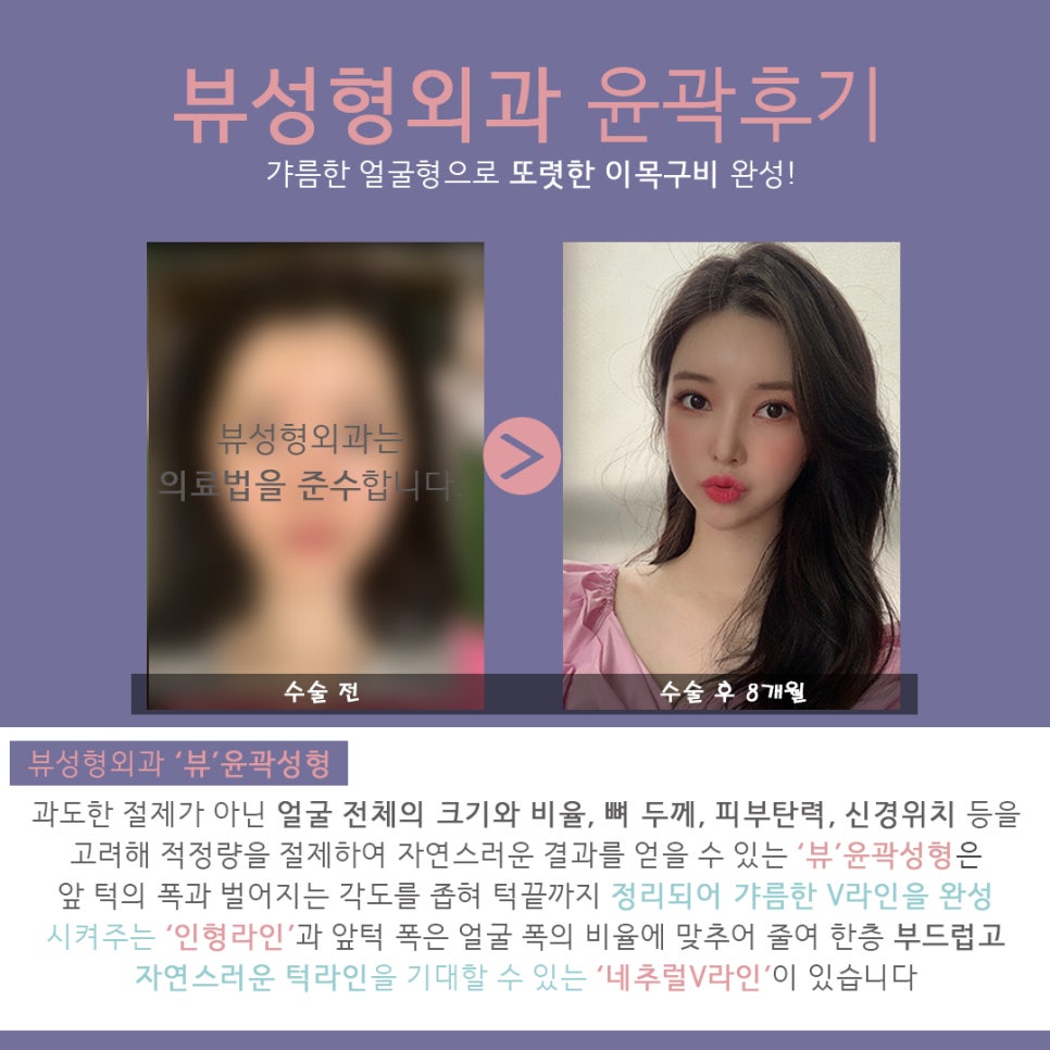 안면윤곽가격 보다 중요한 것은 안전 l 뷰성형외과 관련 이미지 3