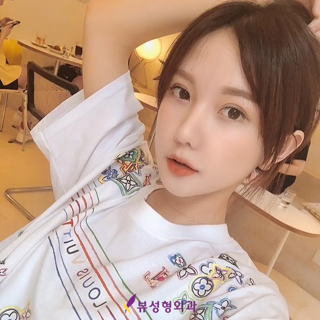 답답한 눈매 또렷해지려면? 뷰성형외과 눈매교정으로 관련 이미지 9