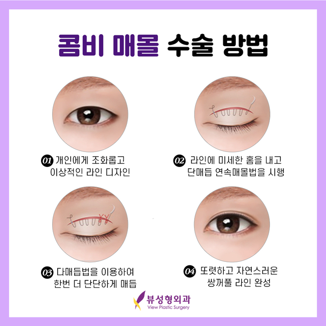 매몰법잘하는곳 뷰성형외과 콤비매몰이라면 관련 이미지 4