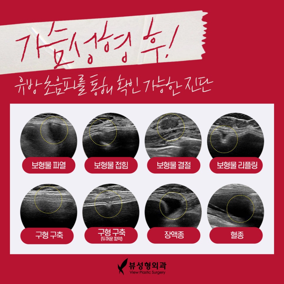 가슴성형잘하는곳 꼼꼼하게 체크해서 관련 이미지 3