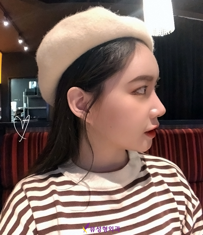 뷰성형외과 코성형잘하는곳 그 이유는? 관련 이미지 1