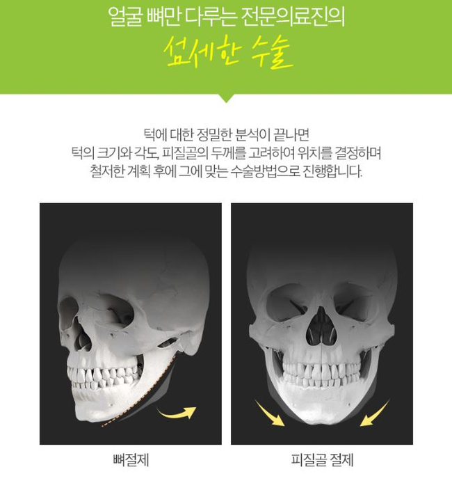 사각턱수술잘하는곳 뷰성형외과 긴곡선사각턱수술로 변화된 모습 관련 이미지 4