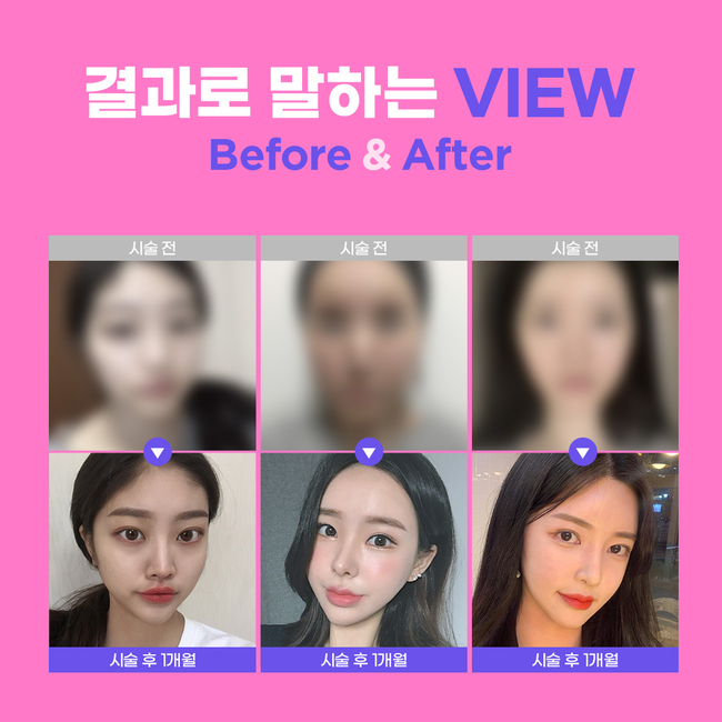 윤곽주사 후기 갸름하게 변화된 비결은 뷰성형외과 관련 이미지 6