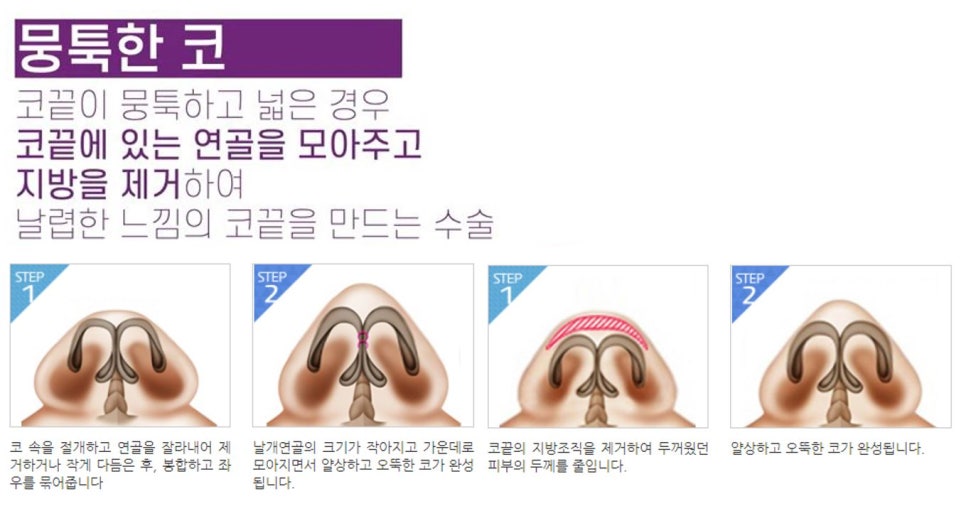 코성형, 개인별 유형에 적합한 수술방법은? 관련 이미지 8