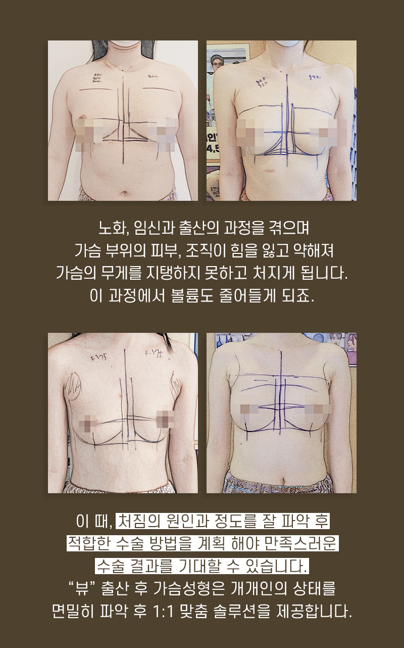 처진가슴수술 고민거리를 줄이고자 한다면 관련 이미지 8
