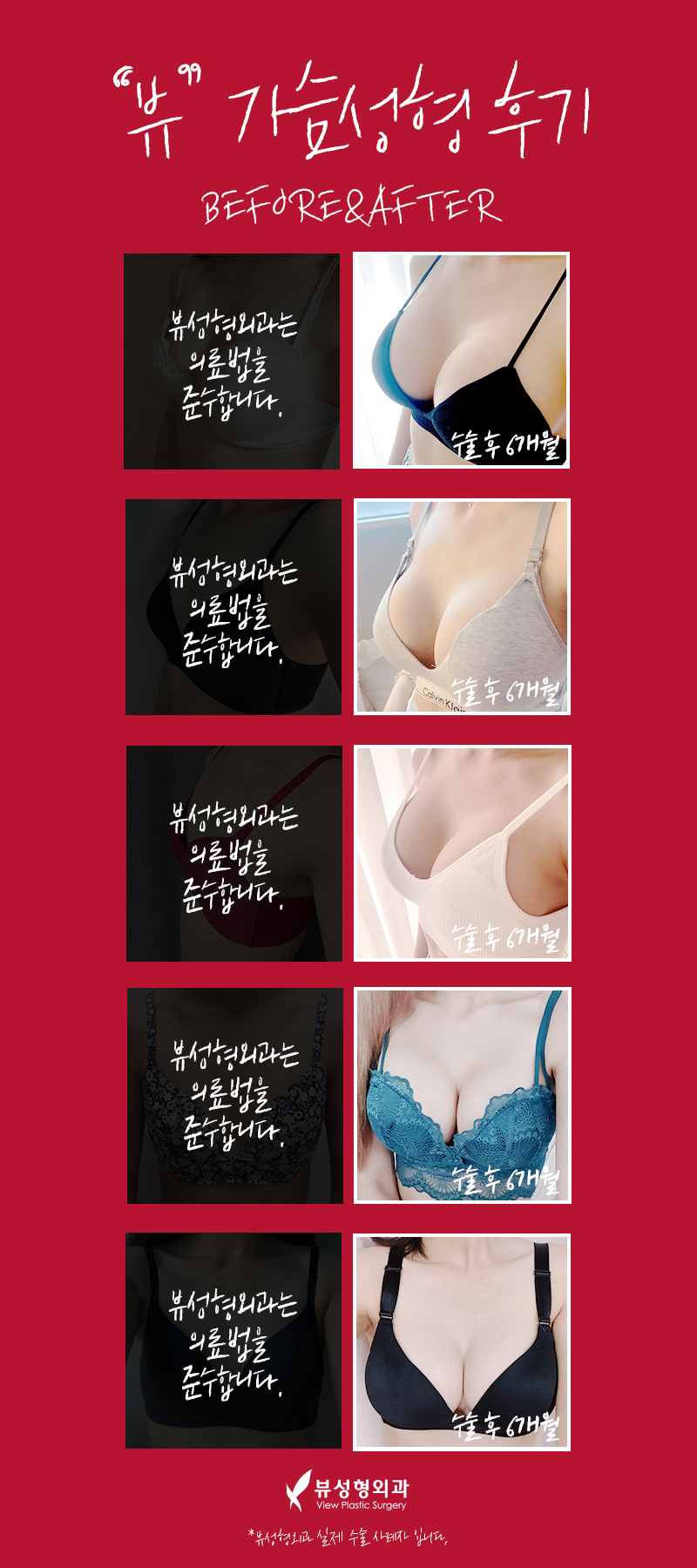 가슴성형잘하는곳 꼼꼼하게 체크해서 관련 이미지 4