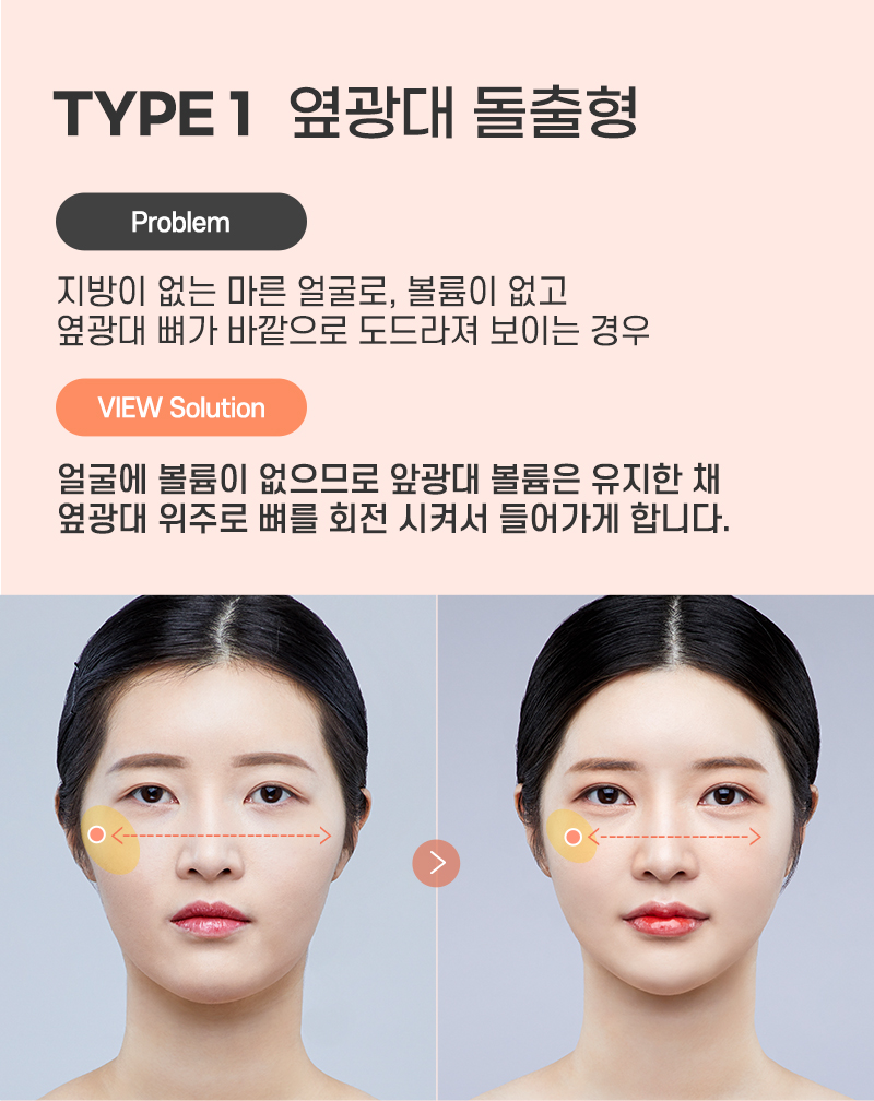 광대축소 하기전에 필수로 알아야 할 것은? 관련 이미지 5