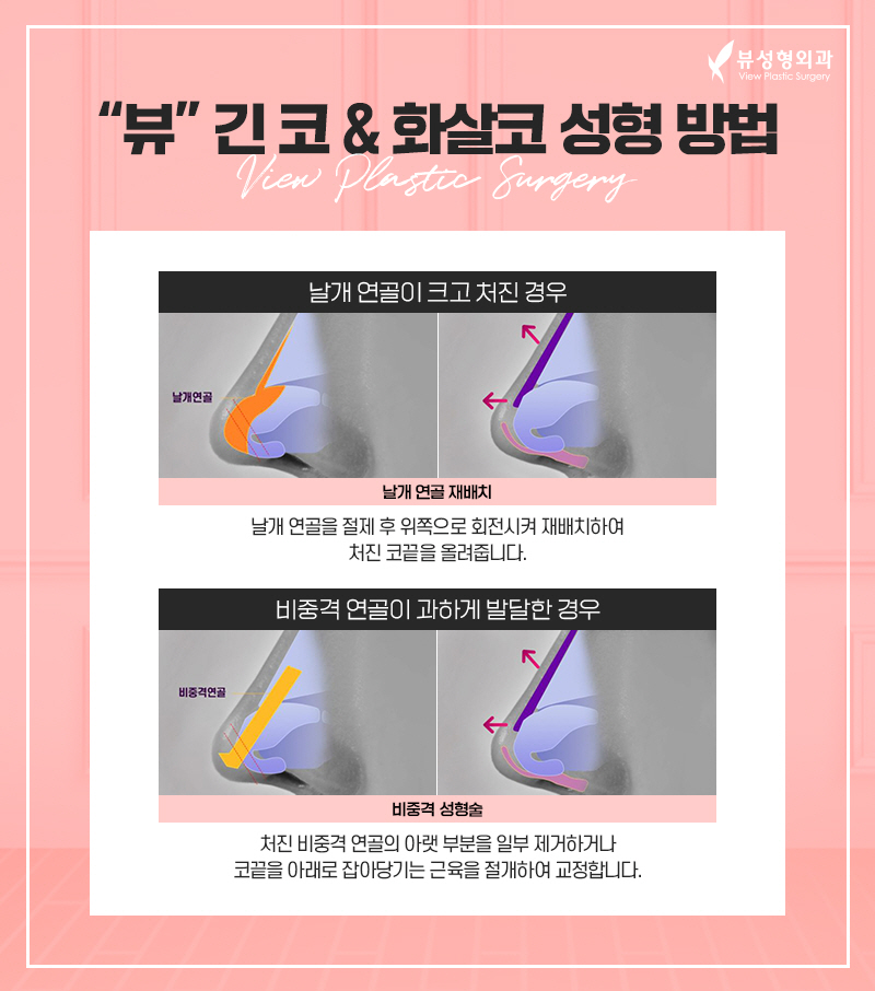 코성형, 개인별 유형에 적합한 수술방법은? 관련 이미지 12