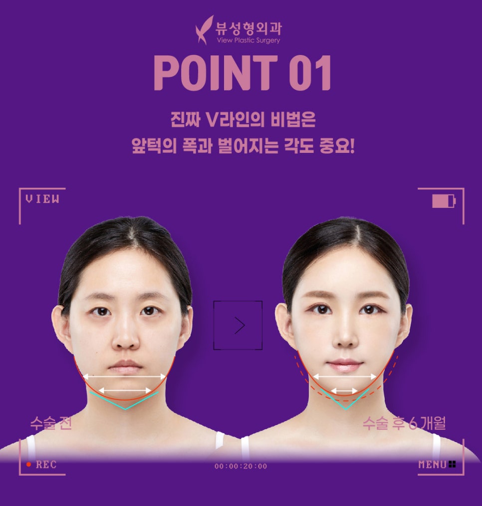 안면윤곽후기, 붓기는 얼마나 갈까? 관련 이미지 3