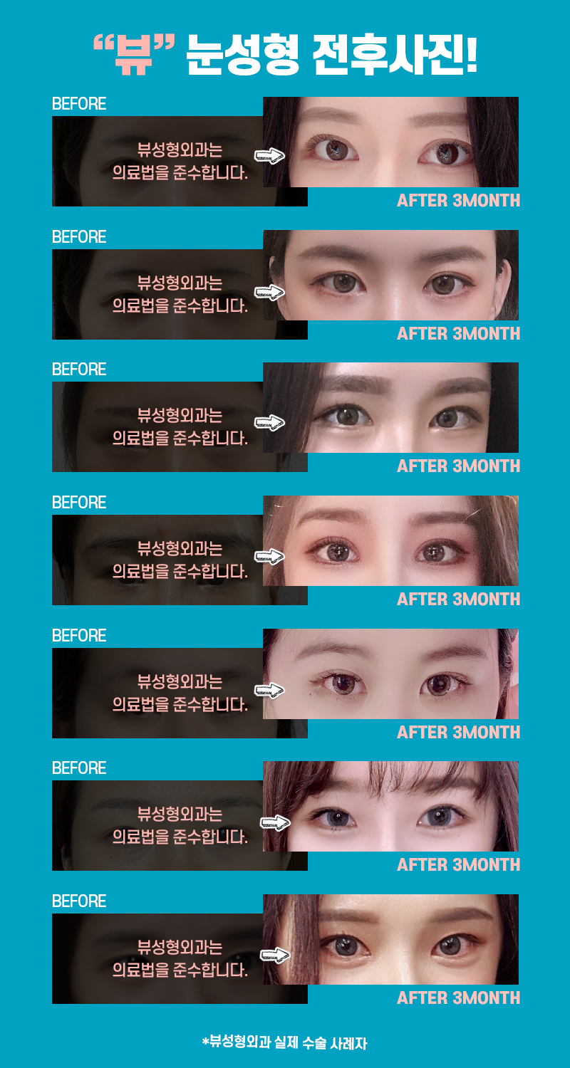 쌍수잘하는곳, 뷰성형외과 관련 이미지 5