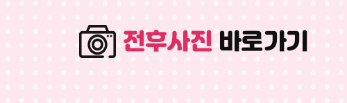 밋밋한 얼굴을 볼륨감 있게 입체적으로 개선하는 지방이식 관련 이미지 8