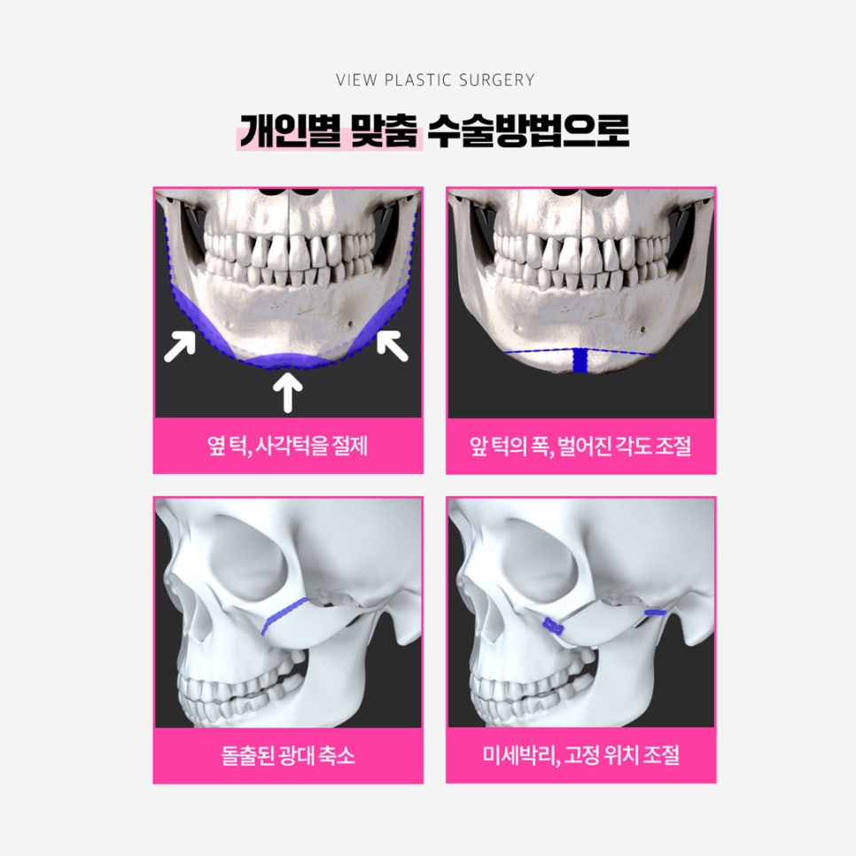 안면윤곽수술회복기간 제대로 알아보자 관련 이미지 7