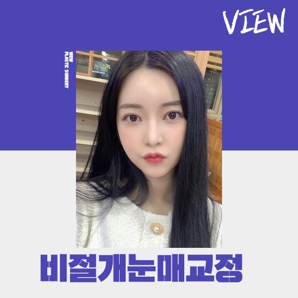 조화로운 비절개눈매교정 하고 싶다면 관련 이미지 9