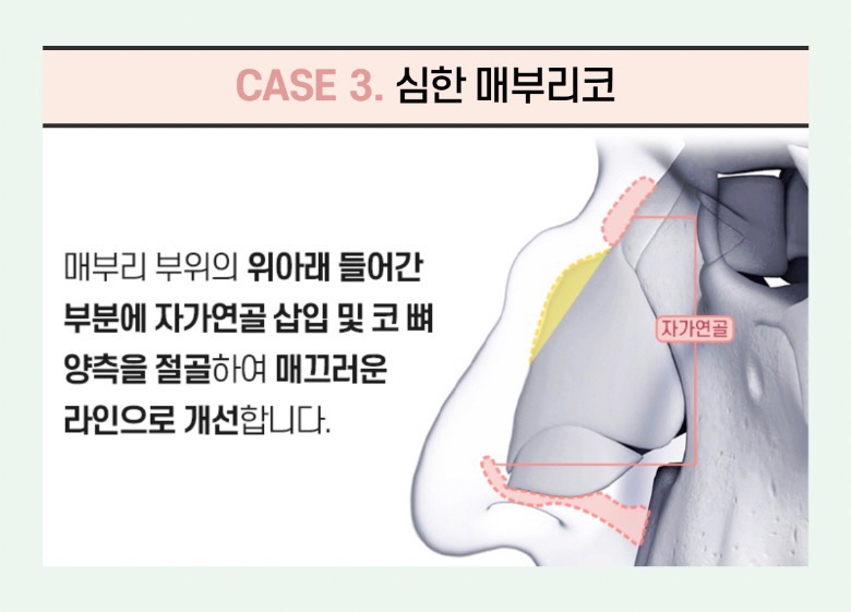 울퉁불퉁한 콧대를 매끈하게, 뷰성형외과 매부리코성형 관련 이미지 9